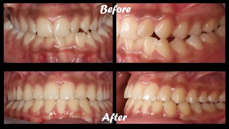 Before and after orthodontic treatment correcting bite alignment and tooth positioning