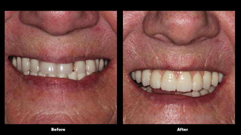 Before and after cosmetic dental treatment showing improved tooth shape and smile aesthetics