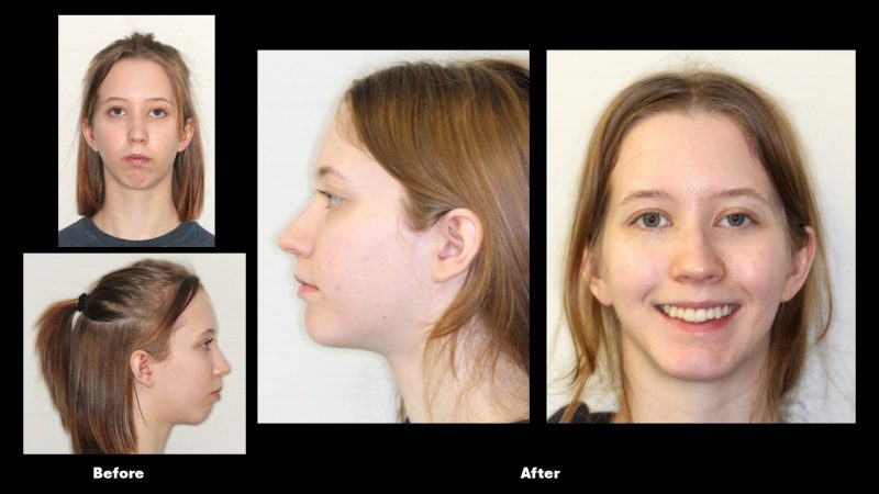 Before and after orthodontic treatment improving facial symmetry and smile appearance