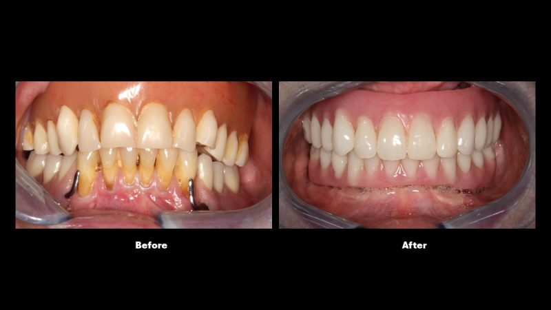 Before and after orthodontic treatment correcting crowded and misaligned teeth