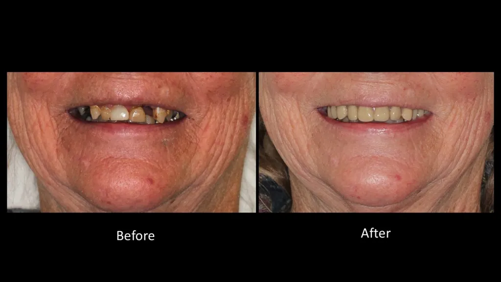Before and after full-mouth restorative dental treatment replacing missing and damaged teeth with a natural-looking smile restoration