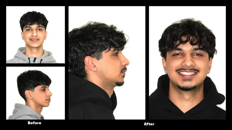 Before and after orthognathic surgery improving facial profile and jaw alignment