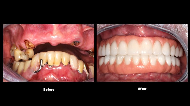 Before and after full mouth restoration improving severely damaged and missing teeth