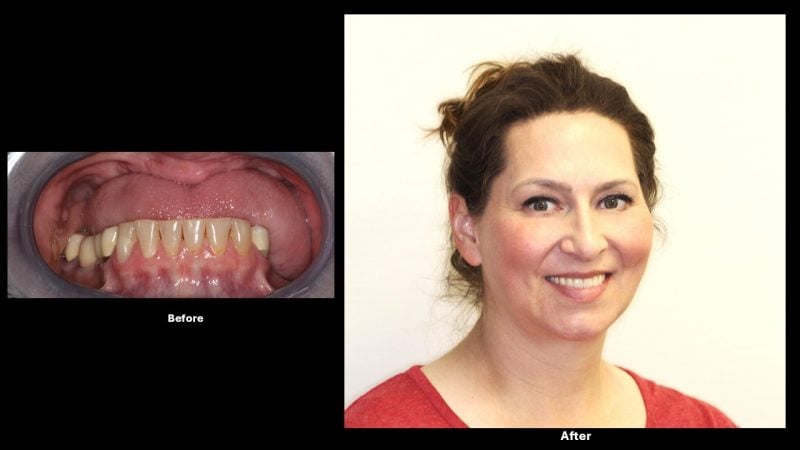 Before and after smile makeover results featuring improved tooth appearance and patient portrait