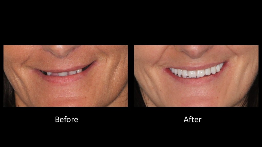 Before and after photos of a patient's smile transformation. The Before image shows worn, stained teeth, and the After image shows a full set of white, even teeth with dental veneers.